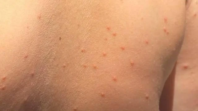 «Зуд купальщика» активно распространяется по российским курортам.