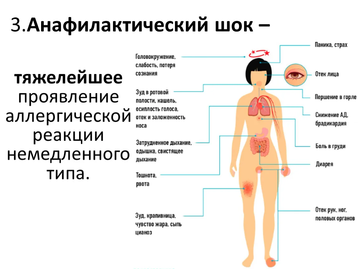 🚨 Анафилаксия и отек Квинке: как распознать и спасти жизнь