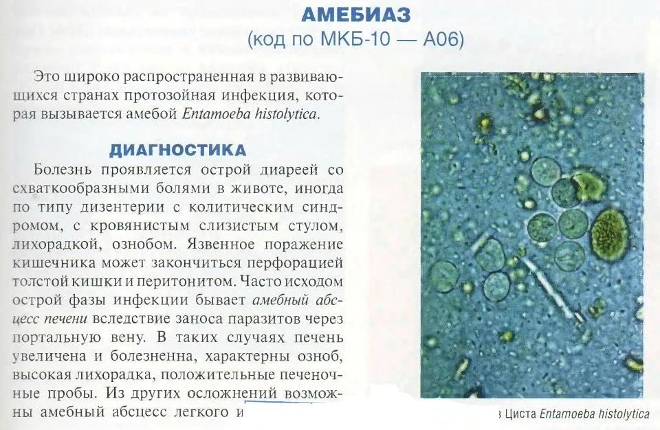 Амебиаз