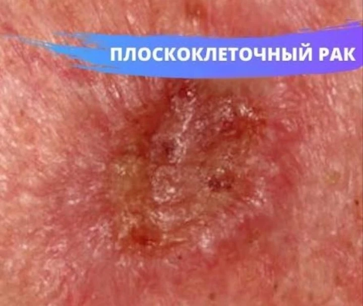🧬 Что такое плоскоклеточный рак — и почему важно не пропустить первые сигналы