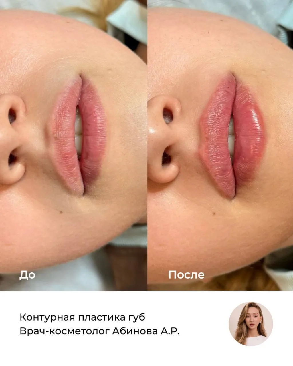 Результат контурной пластики губ от врача-косметолога Азизы Рашидовны Абиновой — сразу ...