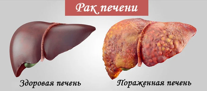 💢Рак печени