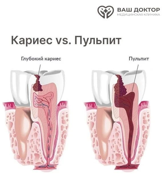 Кариес vs. Пульпит: В чем разница, если коротко?