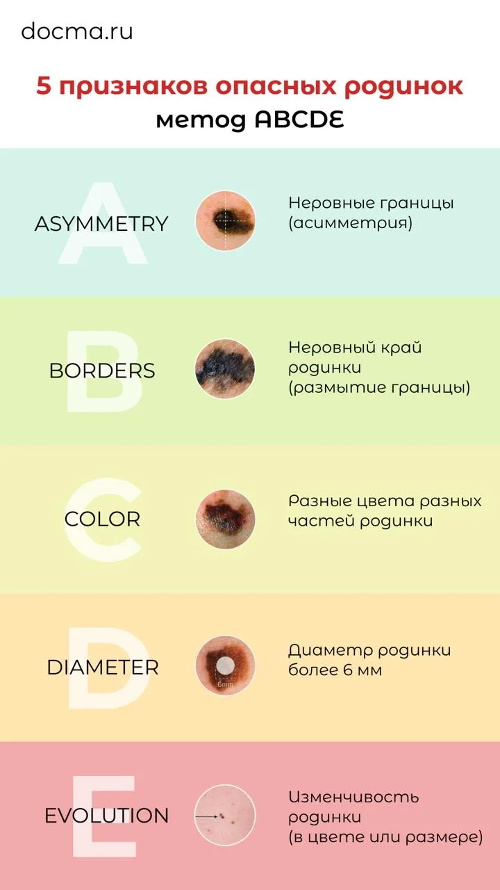 25 мая отмечался День диагностики меланомы кожи