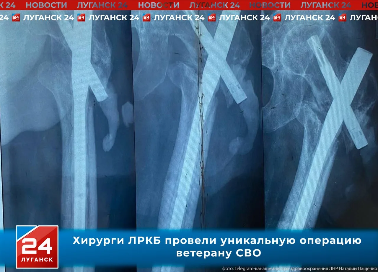 🏥🪖 Уникальная операция: врачи Луганска вернули ветерану СВО возможность ходить без хр...