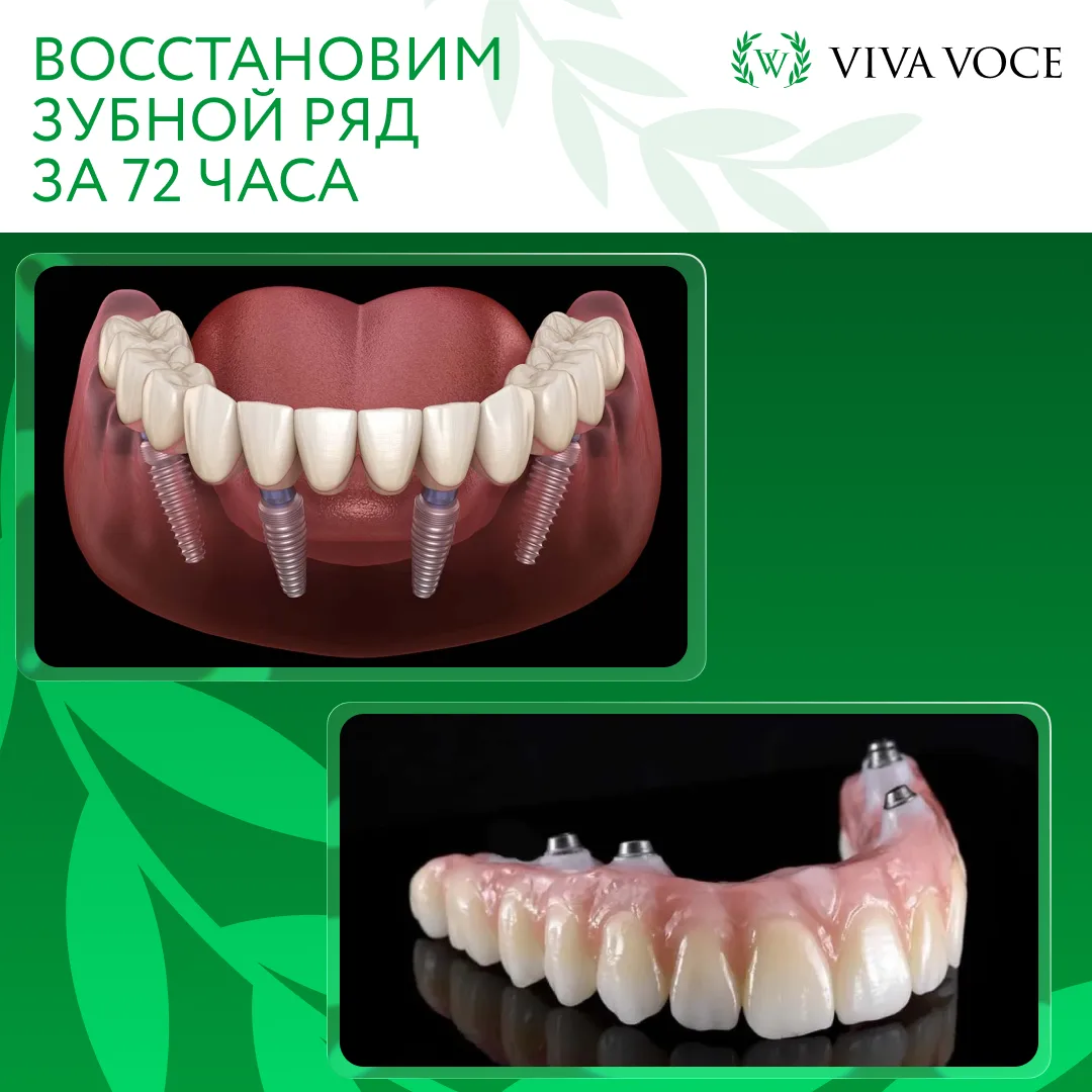 Хотите восстановить весь зубной ряд? Посмотрите на установку "Всё на 4-х"🦷