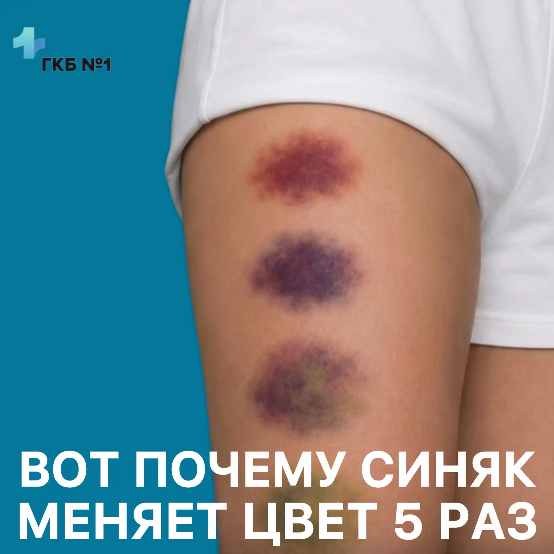 А вы знали, почему синяк меняет цвет? 🤔
