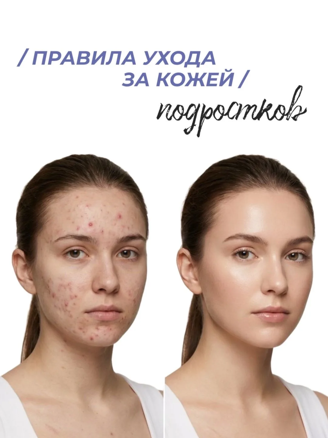 #акне #подростковоеакне