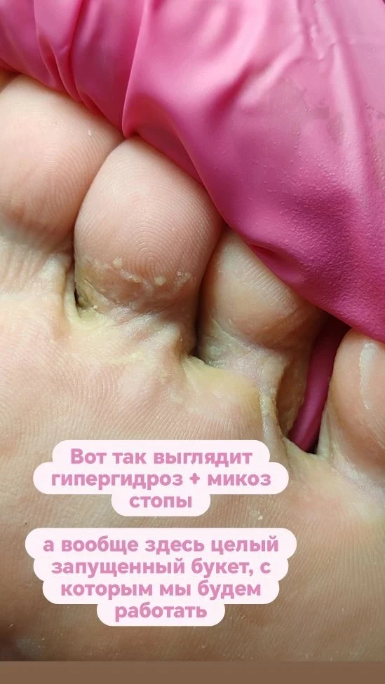 👣ГИПЕРГИДРОЗ + МИКОЗ СТОПЫ