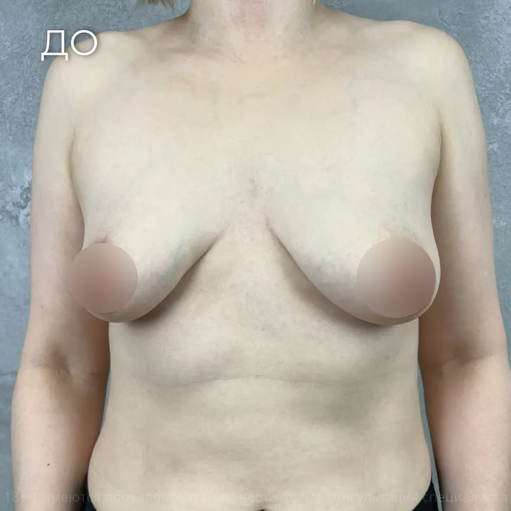 Увеличение и подтяжка груди через 5 недель