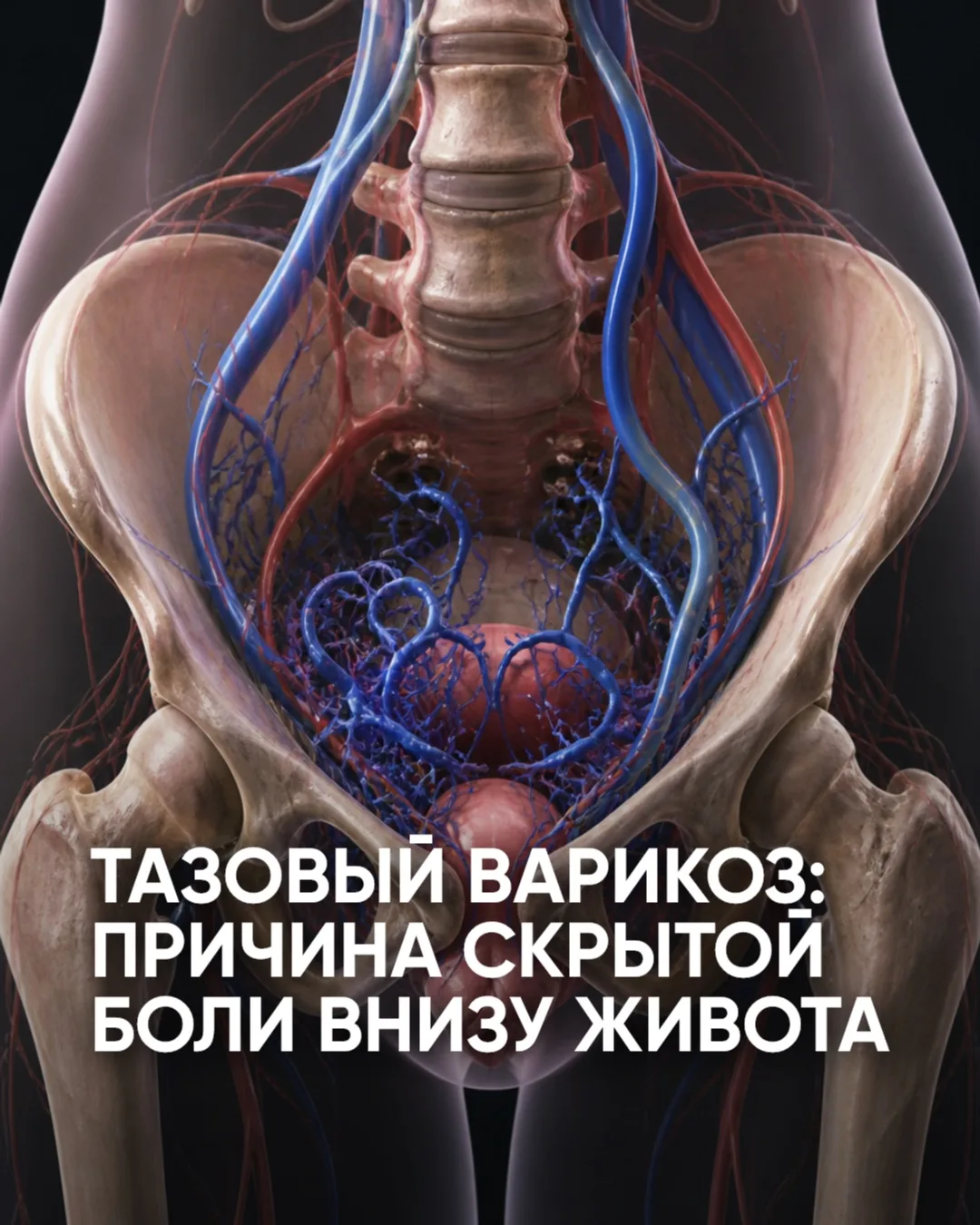 Хроническая боль внизу живота не всегда связана с гинекологией или кишечником.