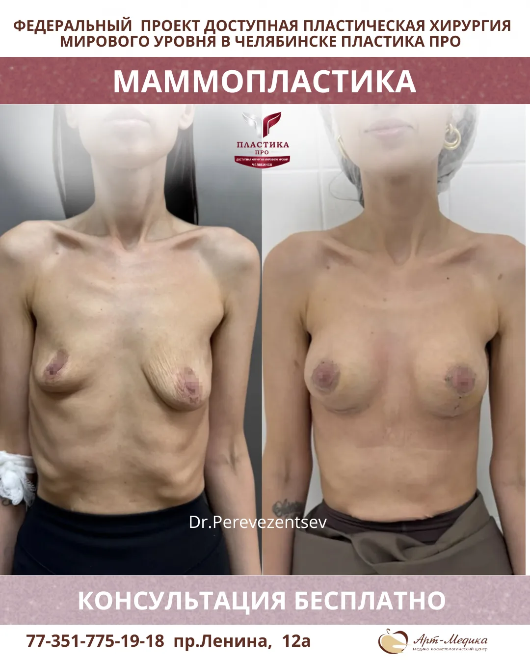 Маммопластика: результат, который говорит сам за себя 🤍