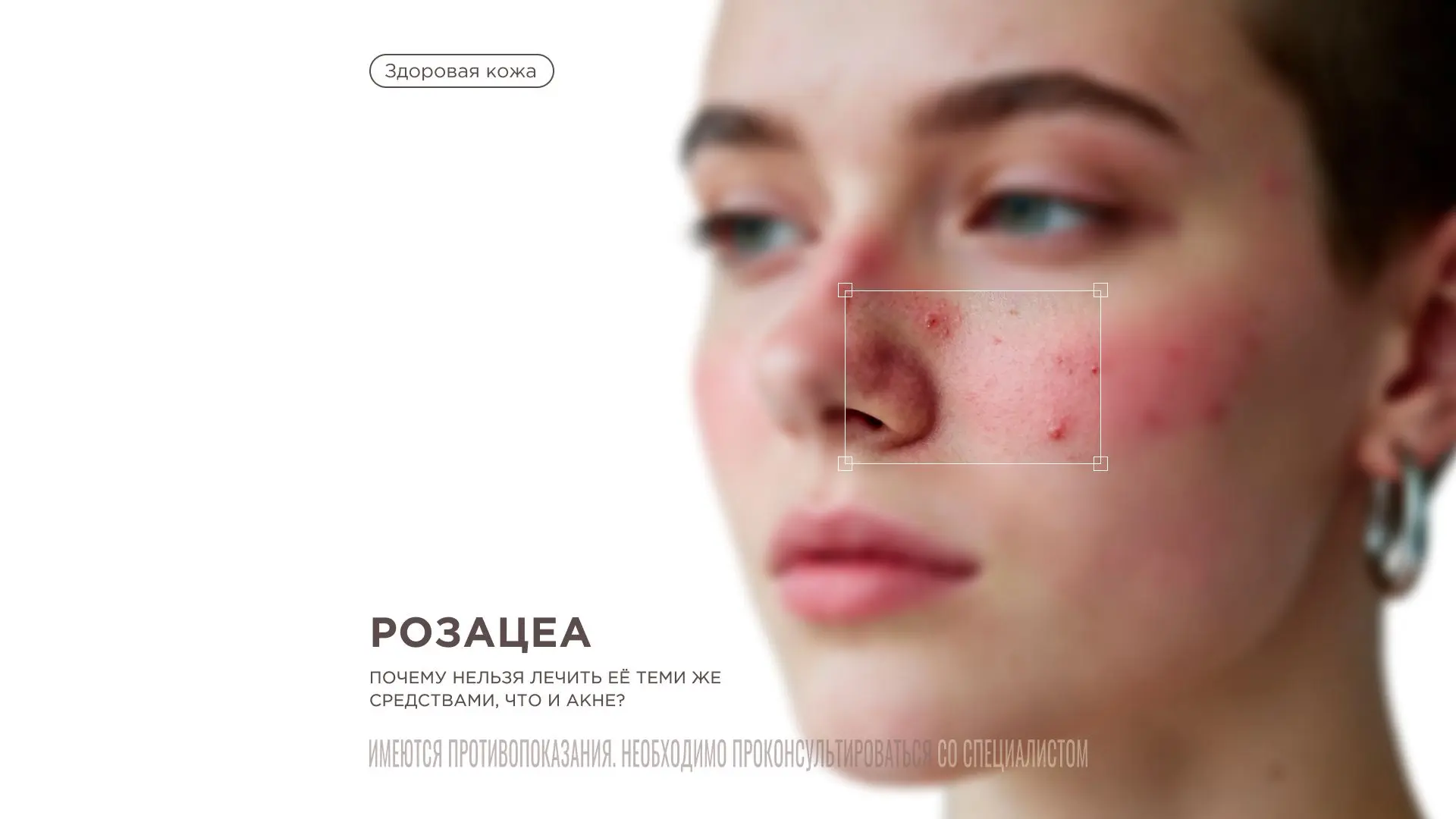 Розацеа: почему нельзя лечить её теми же средствами, что и акне?