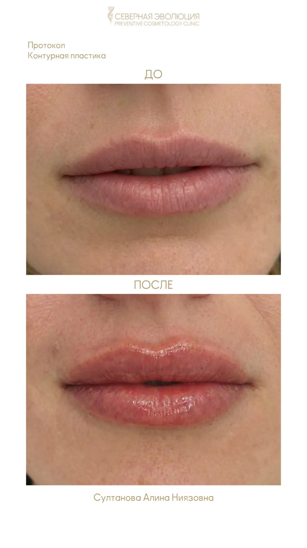 Почему наши врачи выбирают Art Filler Lips💉