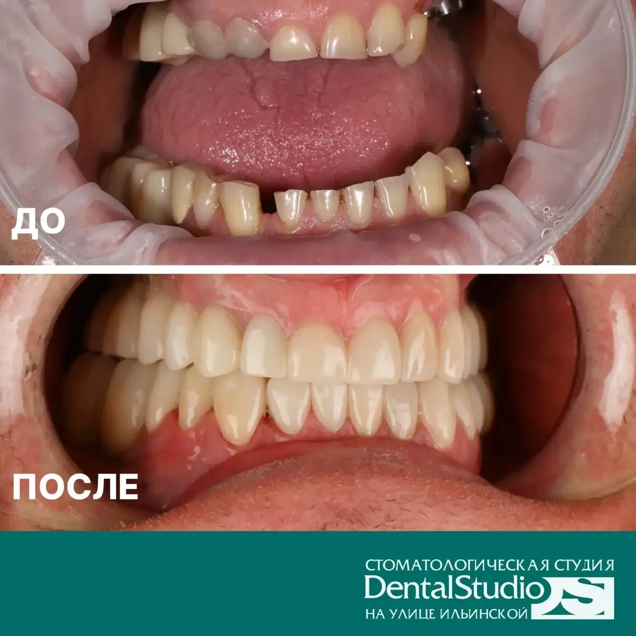 🦷 Впечатляет, правда? Посмотрите на результат «до и после»! 🦷