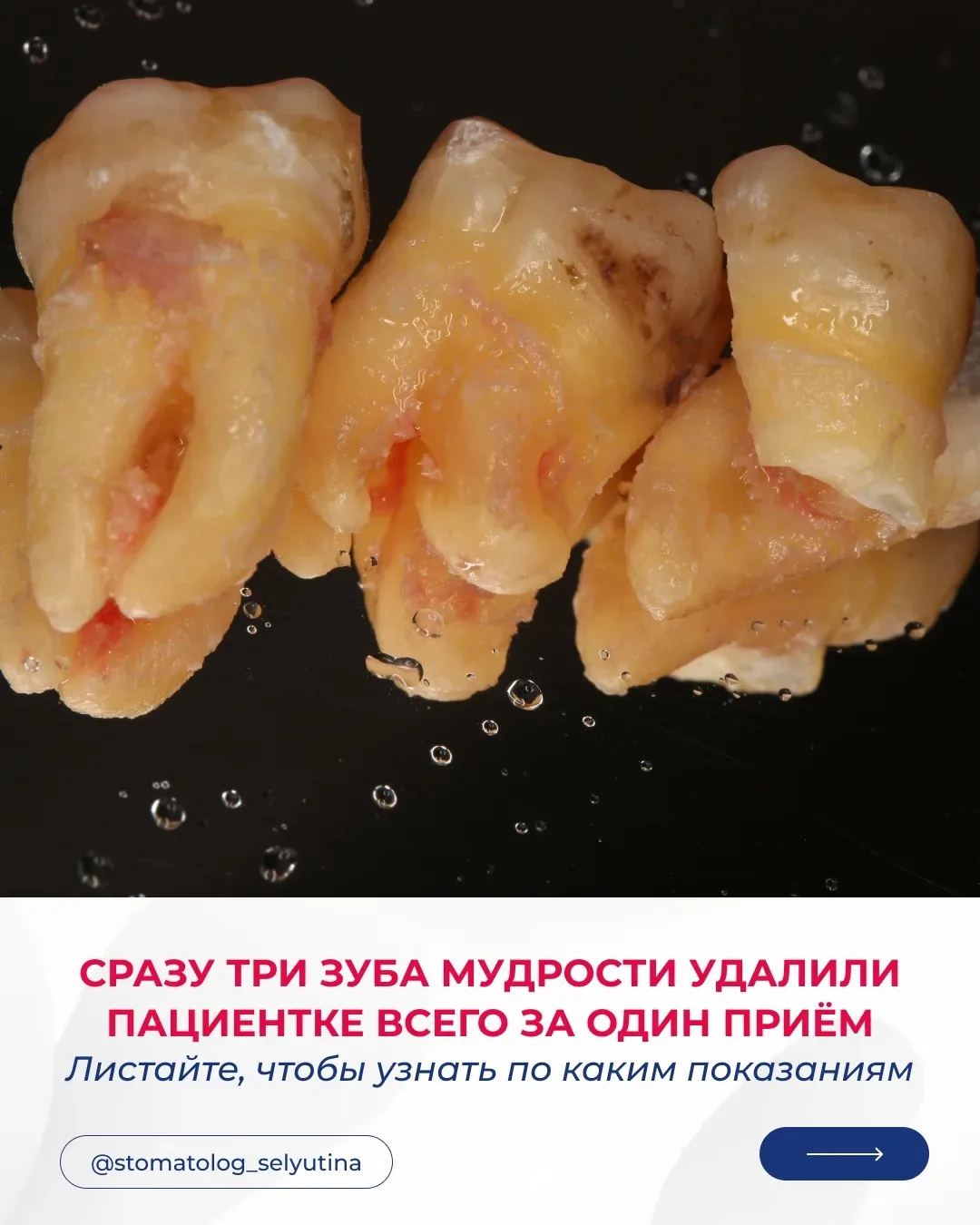 Сразу три зуба удалили пациентке всего за один прием. Это восьмые зубы. Они никак ее не беспокоили и