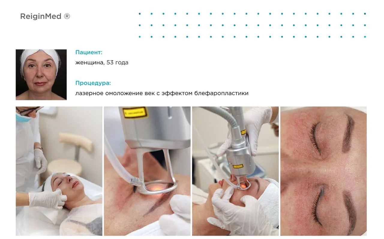 🆔 Кейс DERMAXEL: пациентка 53 года