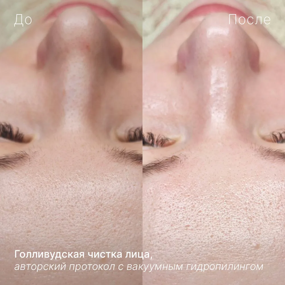 💧 Голливудская чистка лица — для тех, кто обожает ощущение чистой кожи