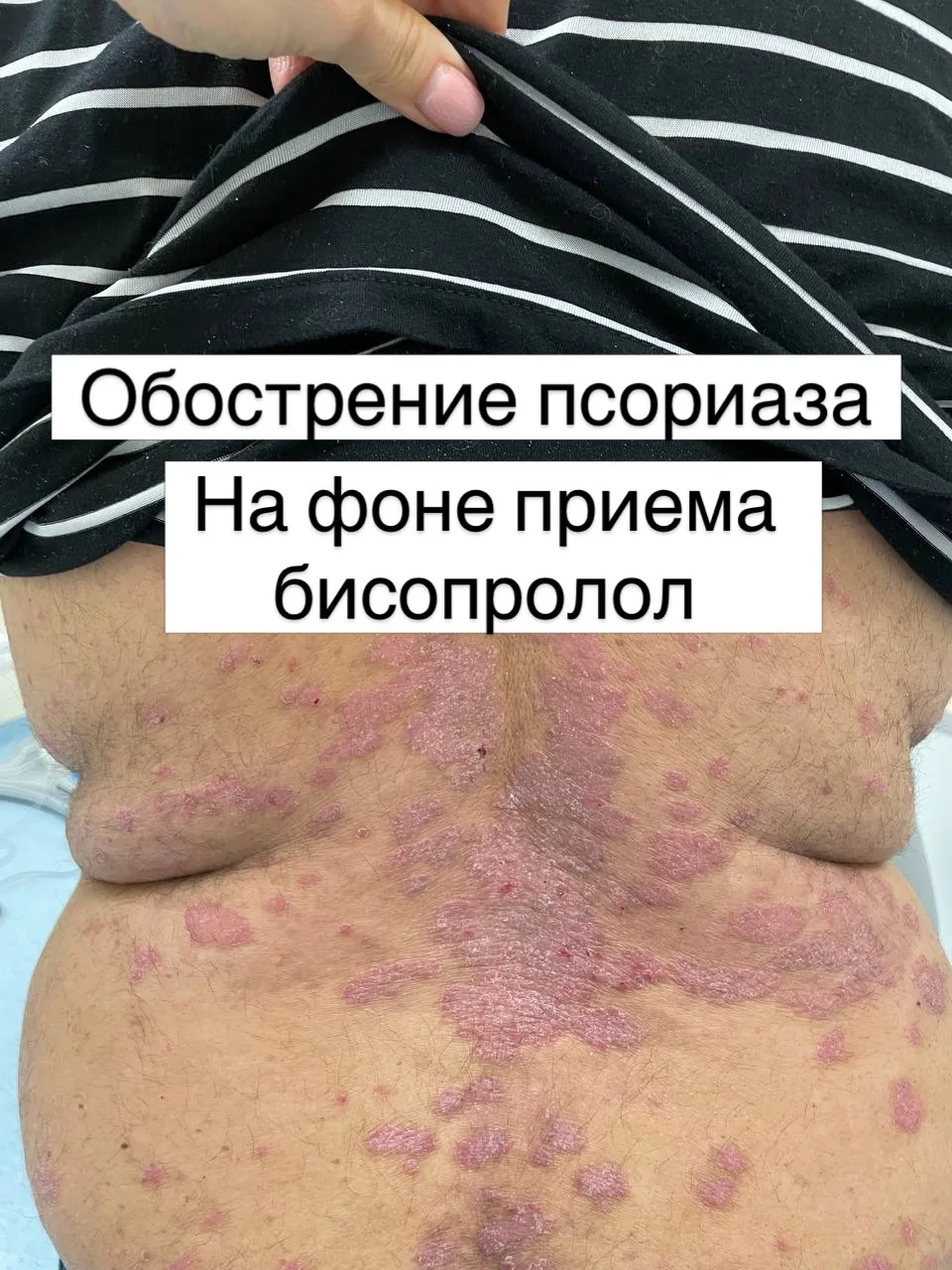 Обострение псориаза на фоне приема бисопролола после стентирования сердца (также в анам...