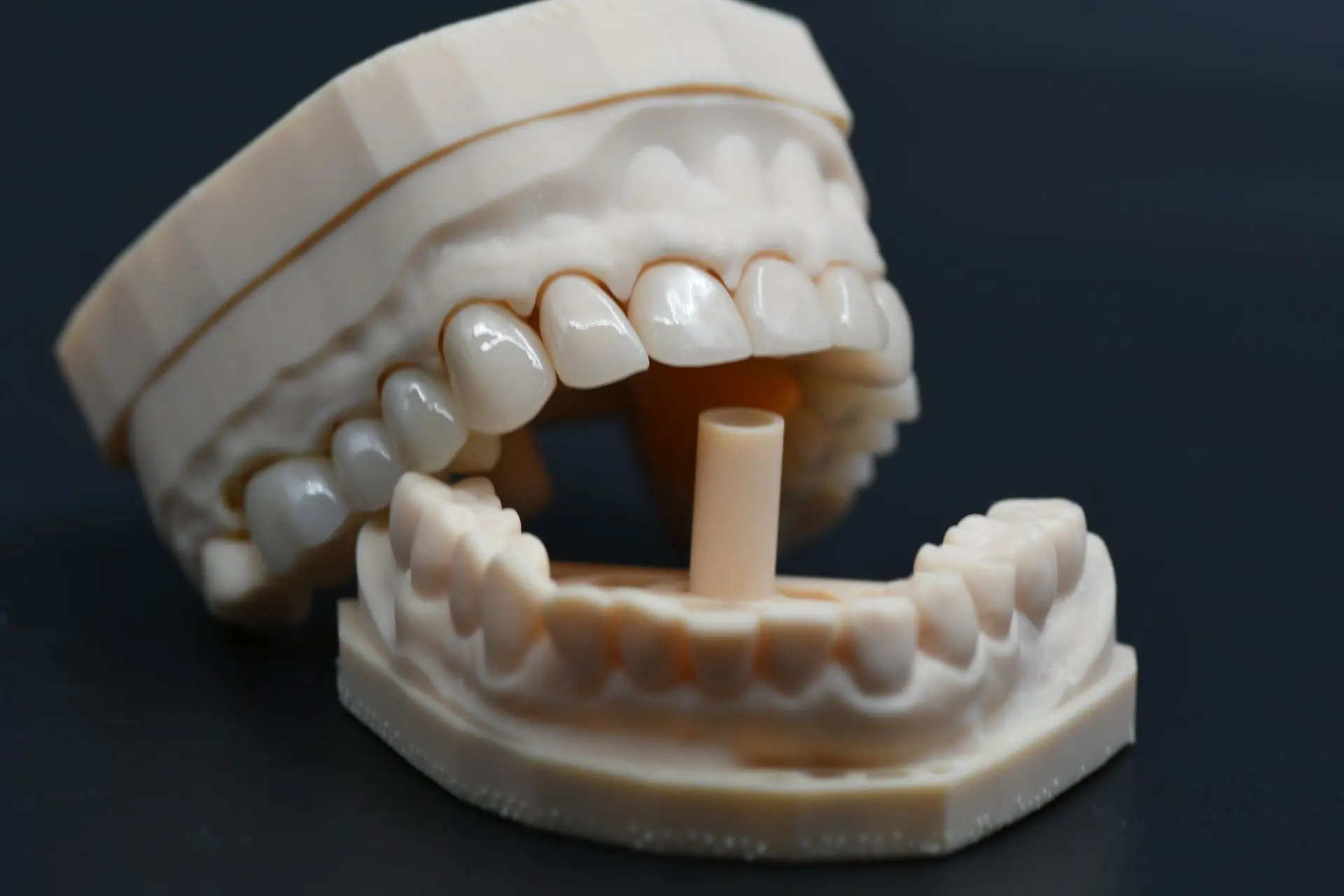 🦷 E.max и цельноциркониевые коронки на винтовой фиксации: цифровой кейс от моделировки...