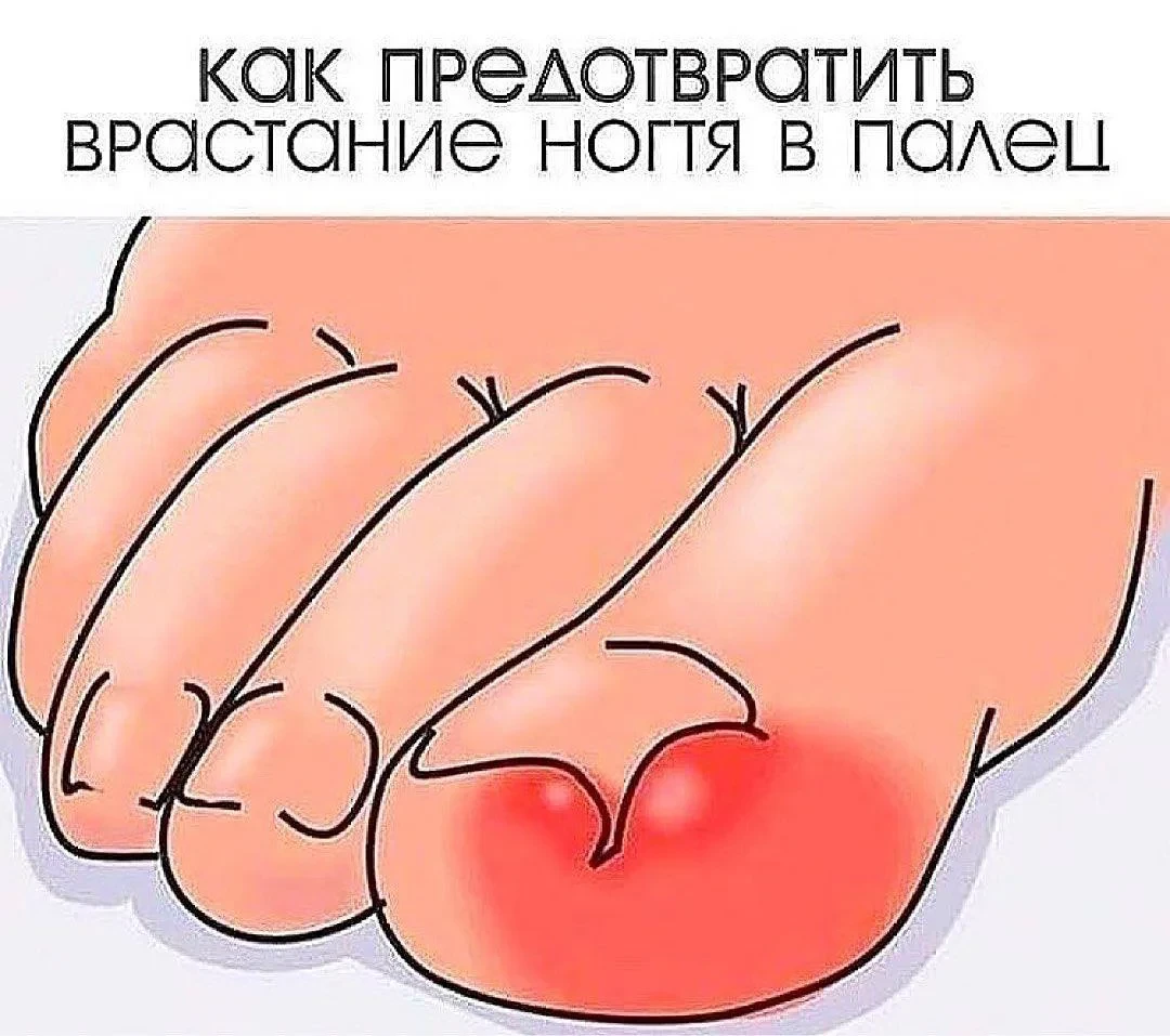 Как предотвратить вростание ногтя в палец! ⚠️

Врастающийся в палец ноготь начинает давить на край н