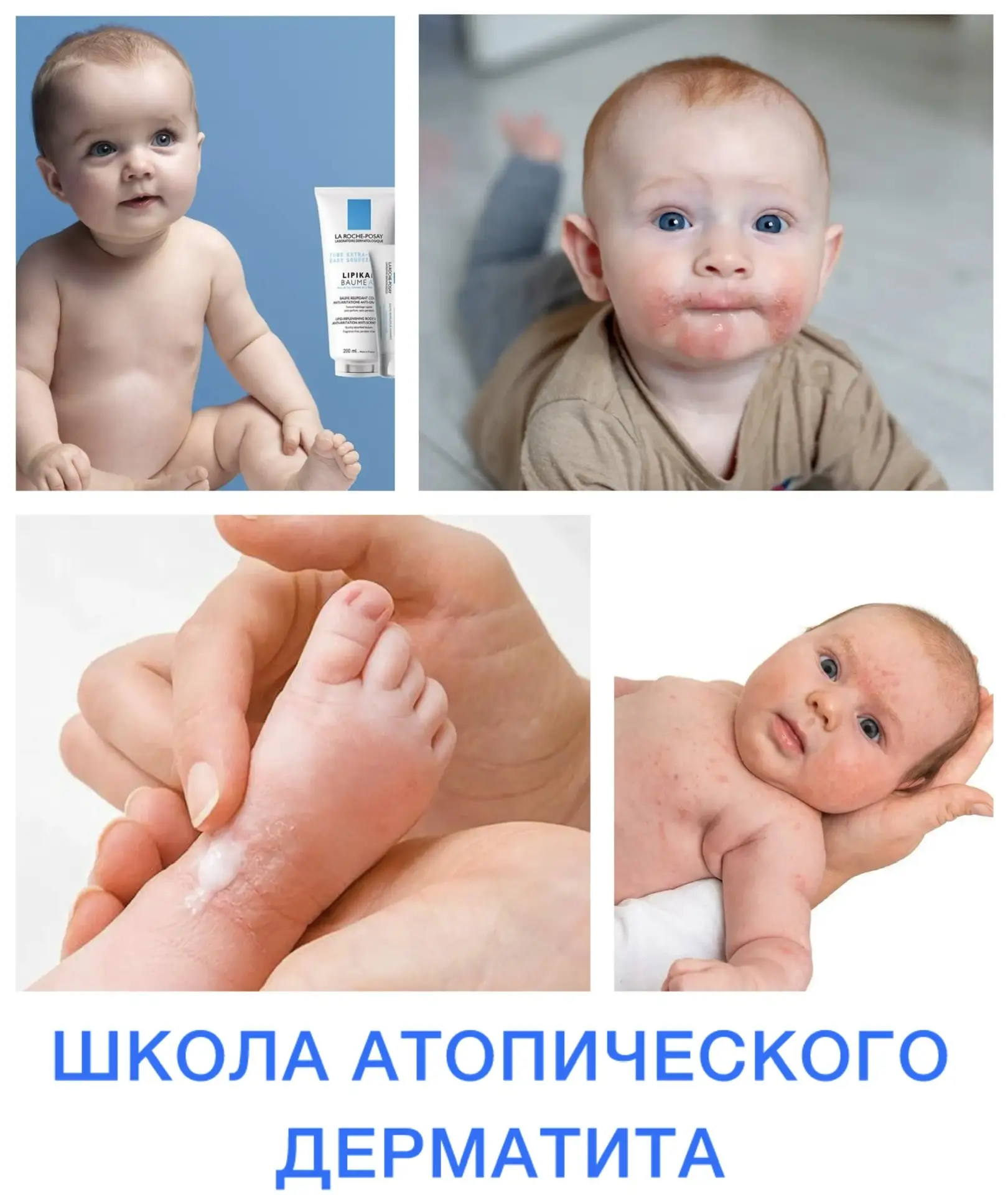 📣Напоминаем, что если у вашего ребенка атопический дерматит, то помимо лечения этого с...