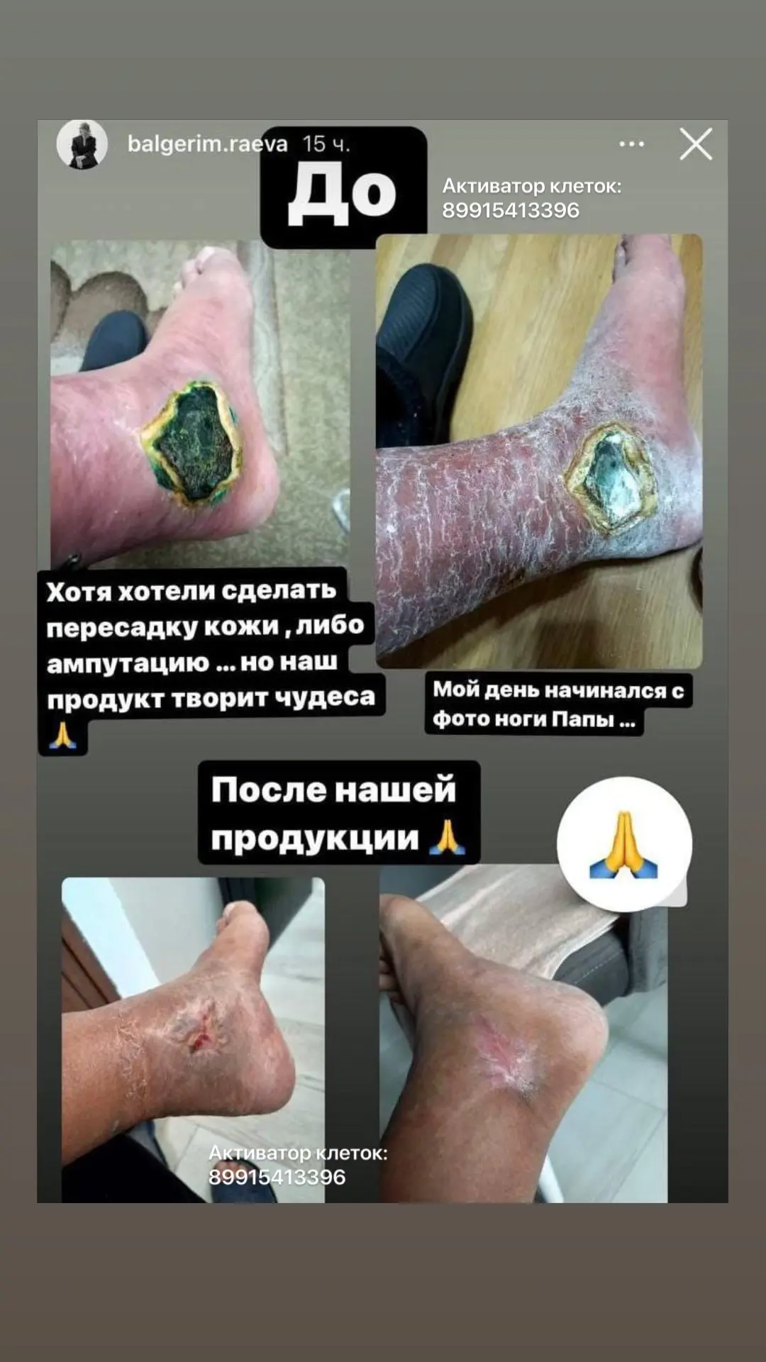 Еще диабетическая стопа.