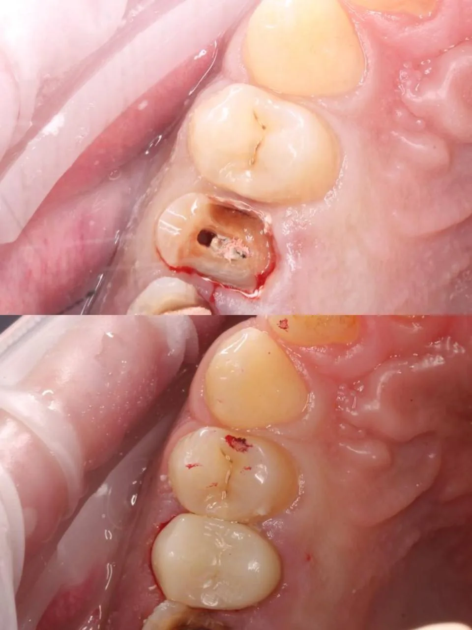Удалять нельзя, спасти! Как мы сохранили зуб, который был на грани 🦷