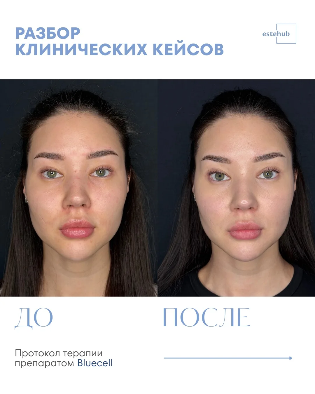 ✨Разбор клинического кейса | Bluecell