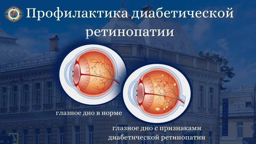 ⚡Диабетическая ретинопатия - это тяжелое осложнение сахарного диабета, при котором поражаются сосуды
