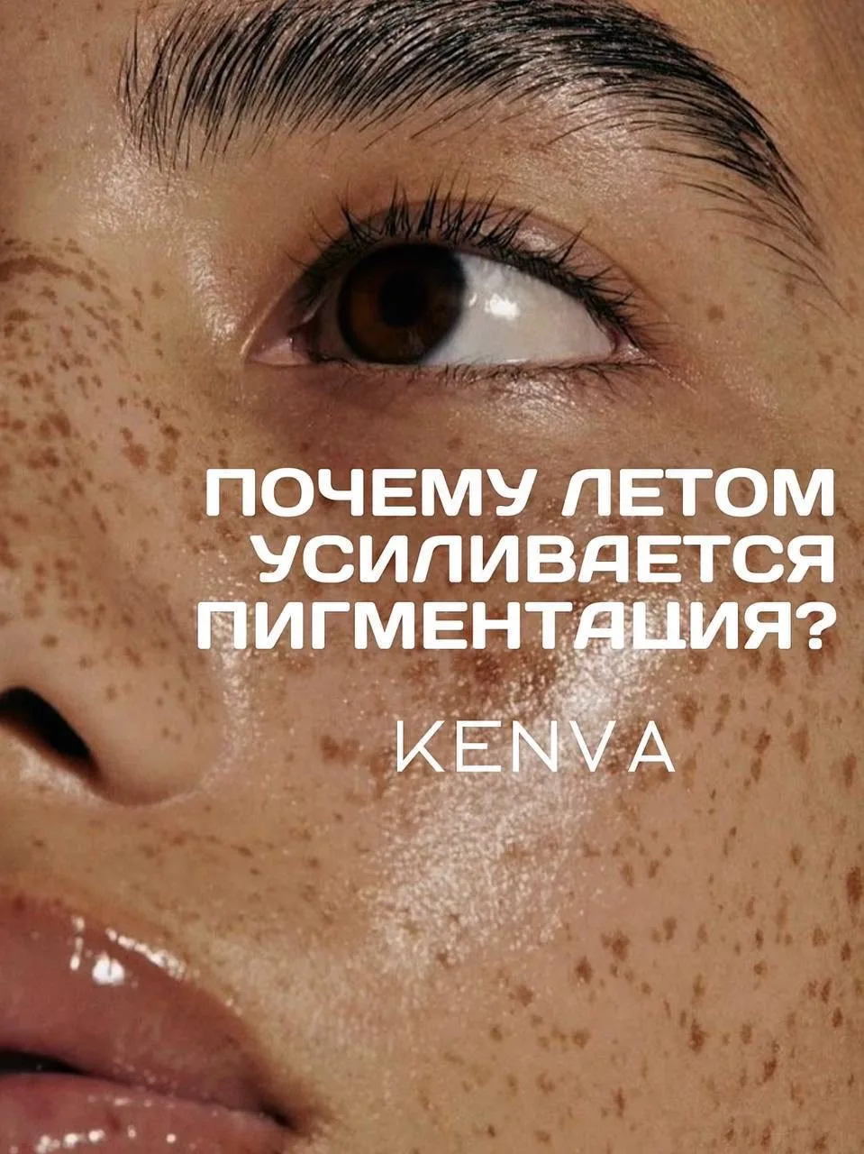 ЛЕТОМ ПИГМЕНТАЦИЯ СТАНОВИТСЯ ЯРЧЕ.
Почему так происходит? ☀️

Кажется, что после отпуска кожа выгляд