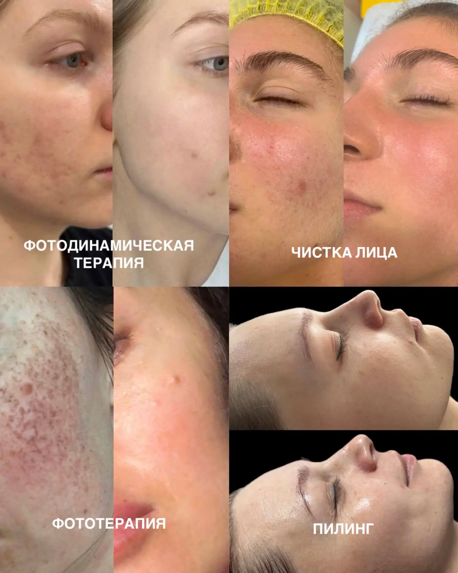 Хотите чистую, сияющую, ровную и здоровую кожу — но без уколов? ✨