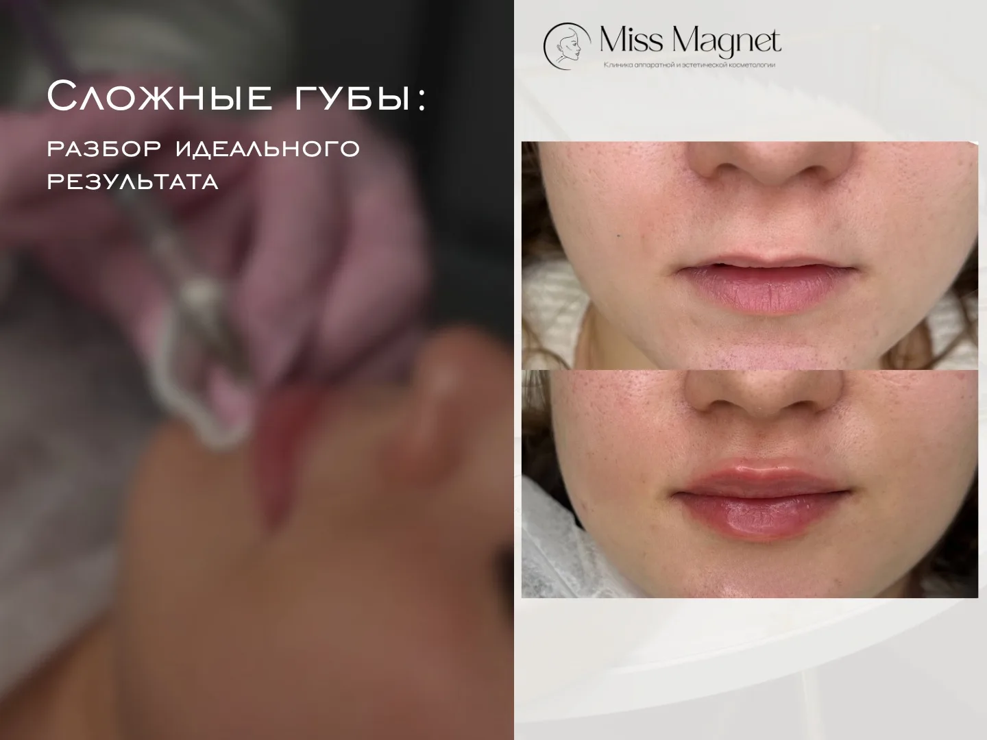 Даже самые сложные губы можно сделать гармоничными и естественными ❤️