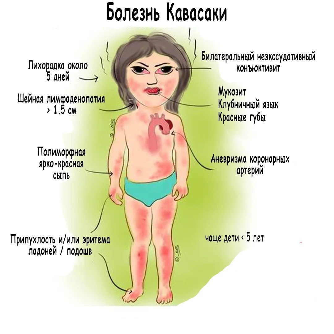 Симптомы болезни Кавасаки