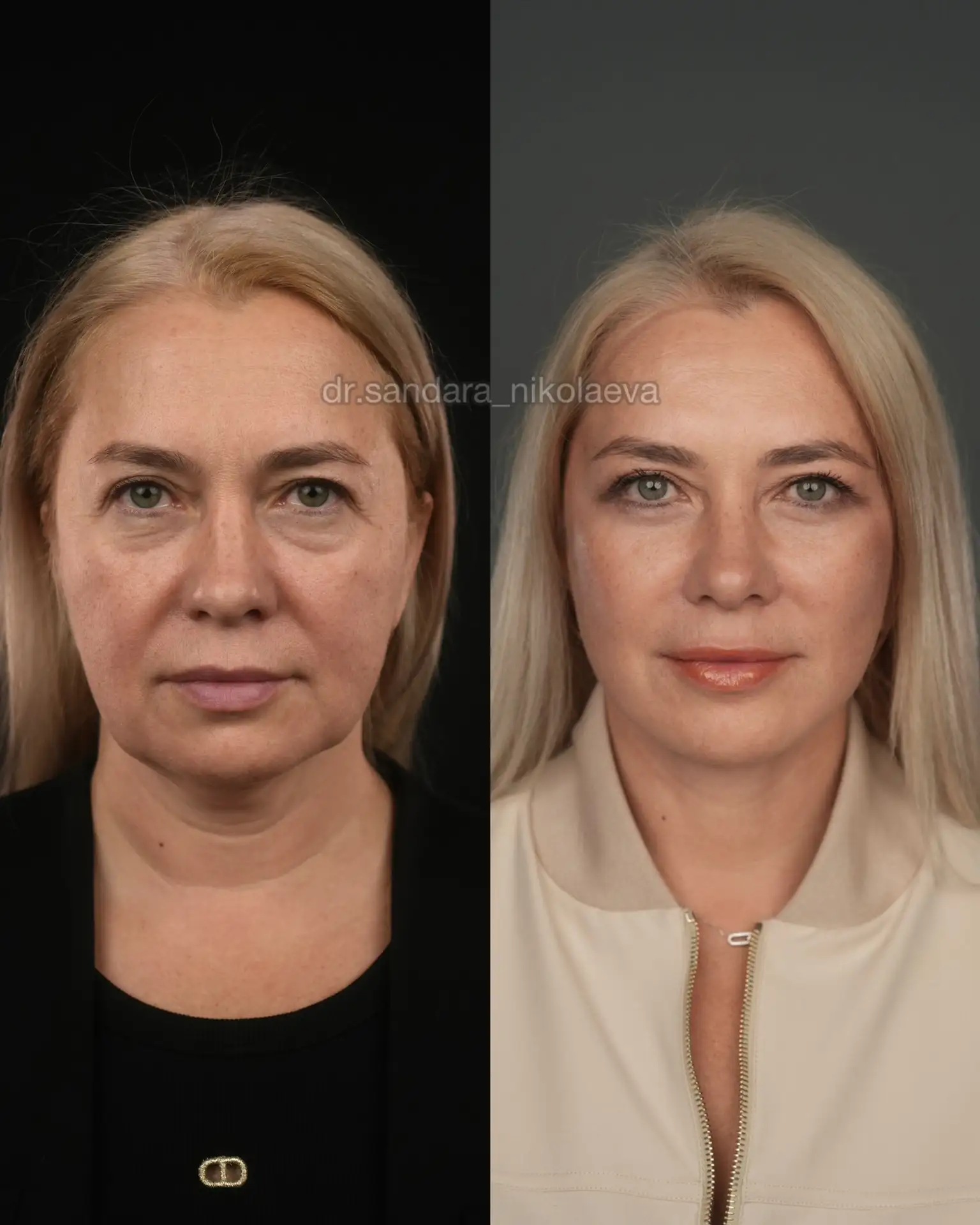 Полгода после омоложения😍