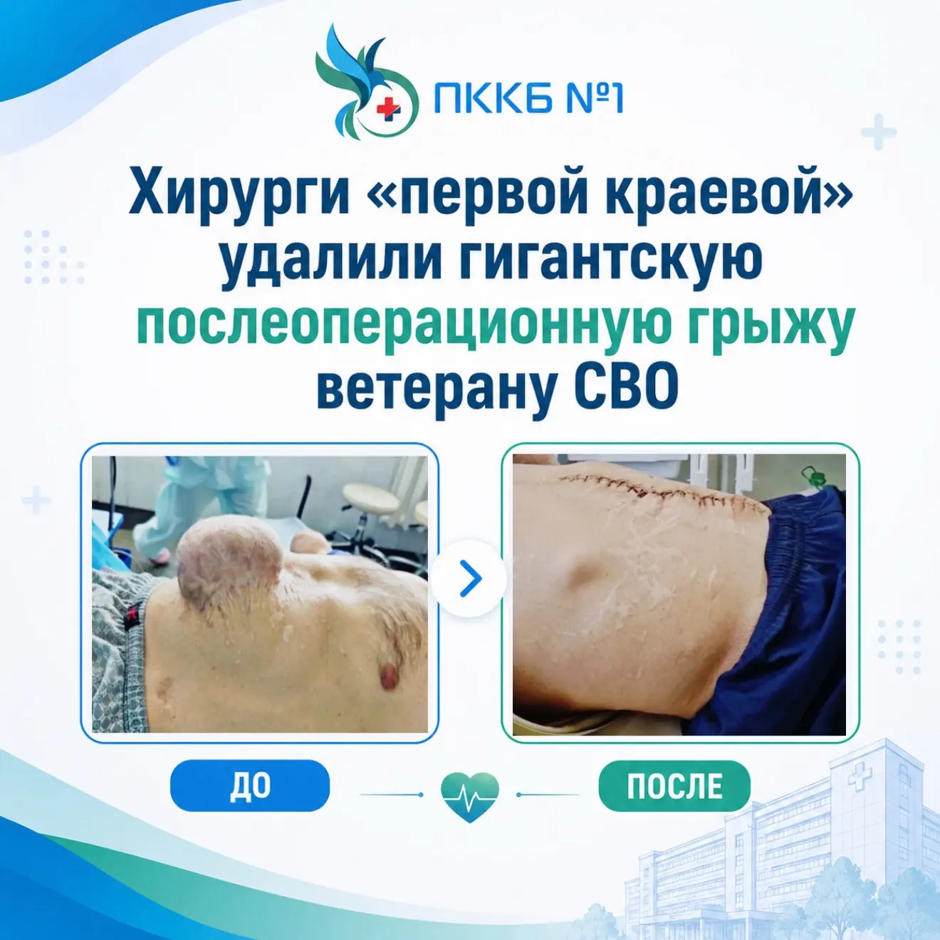 Хирурги «первой краевой» удалили гигантскую послеоперационную грыжу ветерану СВО