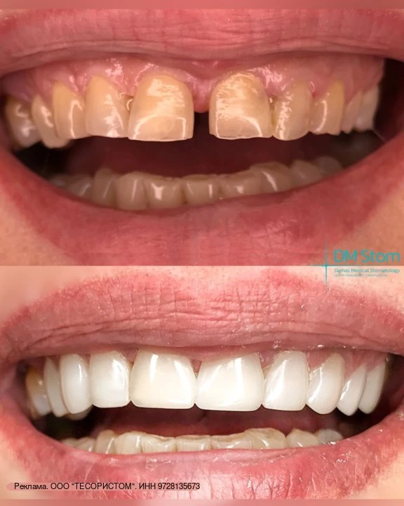 Получите композитные виниры со скидкой 50% в Damas_Denta!