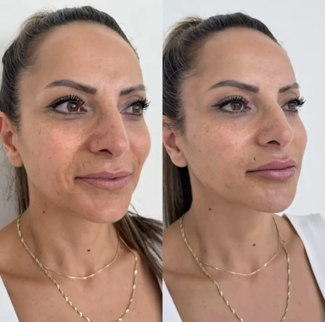 Девочки,здесь проведены 2 процедуры ❤️
Ботокс «Full Face»-7500,вместо 14000
Губы+носогубная складка-