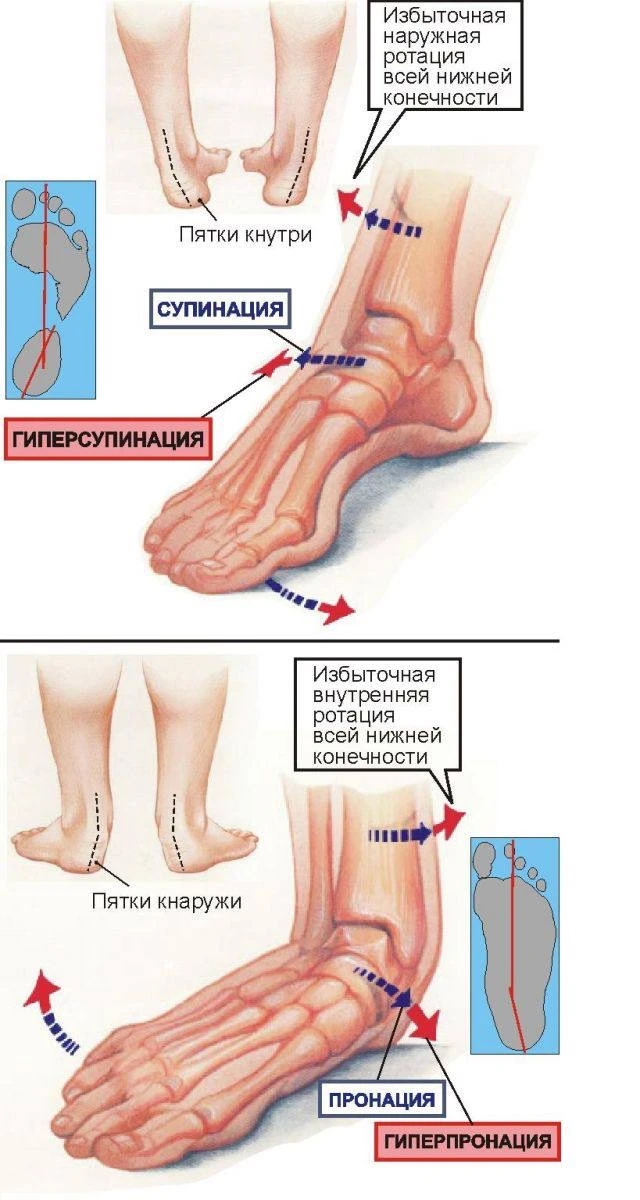 👣 ПОЧЕМУ СТОПА ЗАВАЛИВАЕТСЯ ВНУТРЬ ИЛИ НАРУЖУ?   Скажем сразу, не надо думать, что все проблемы от с
