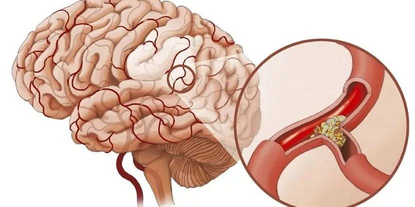 Помощь сосудам головного мозга 🧠

▪️Рецепт
10-граммовую горсточку корней лопуха насыпать в термос. 
