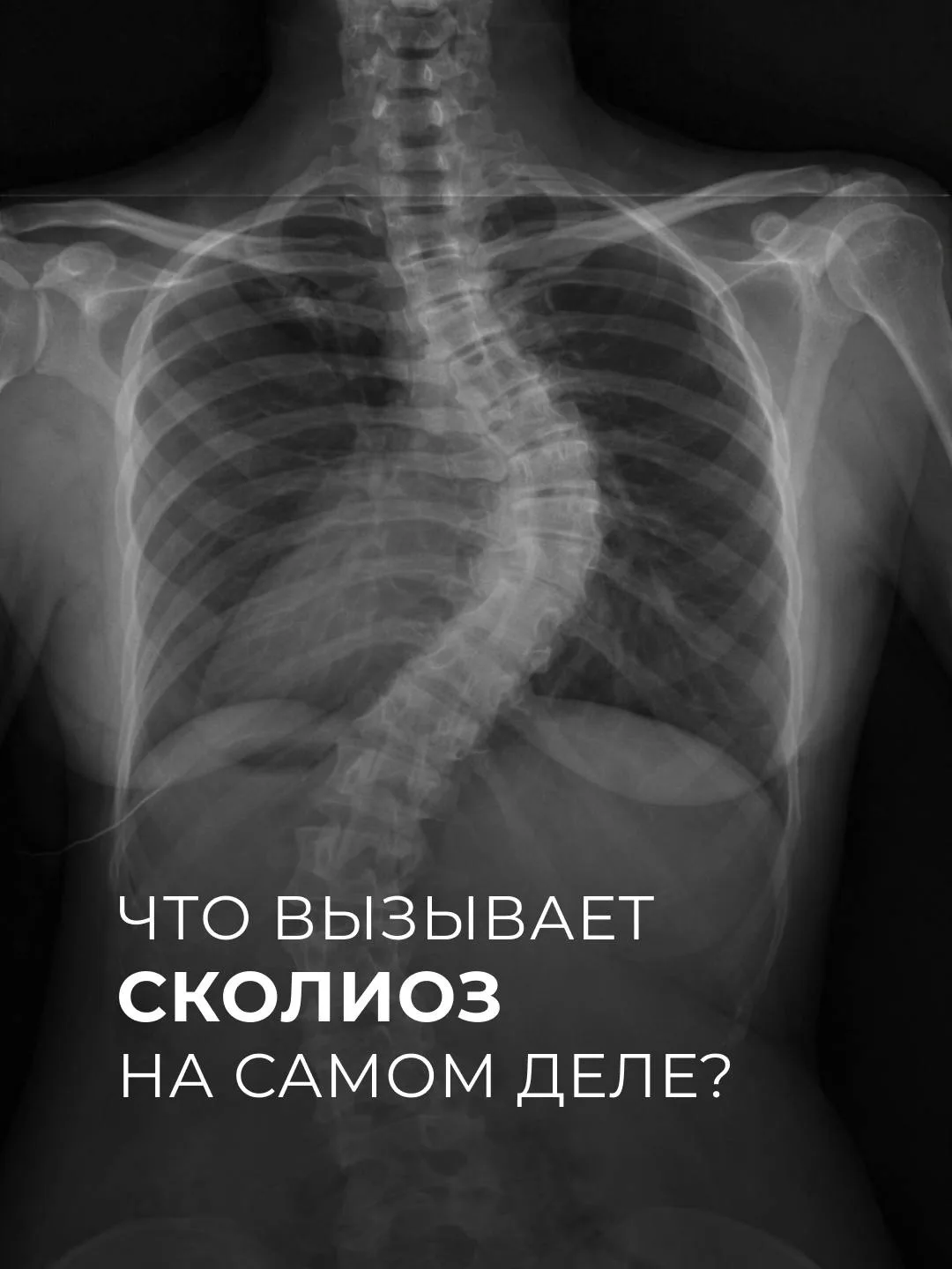 Что вызывает сколиоз?
Сколиоз — это трёхплоскостная деформация позвоночника. Речь идёт об идиопатиче