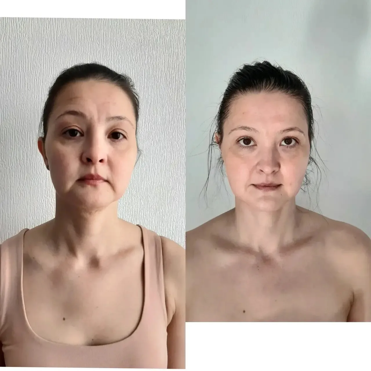 Всего 2 процедуры → 1 раз в неделю → невероятный результат!