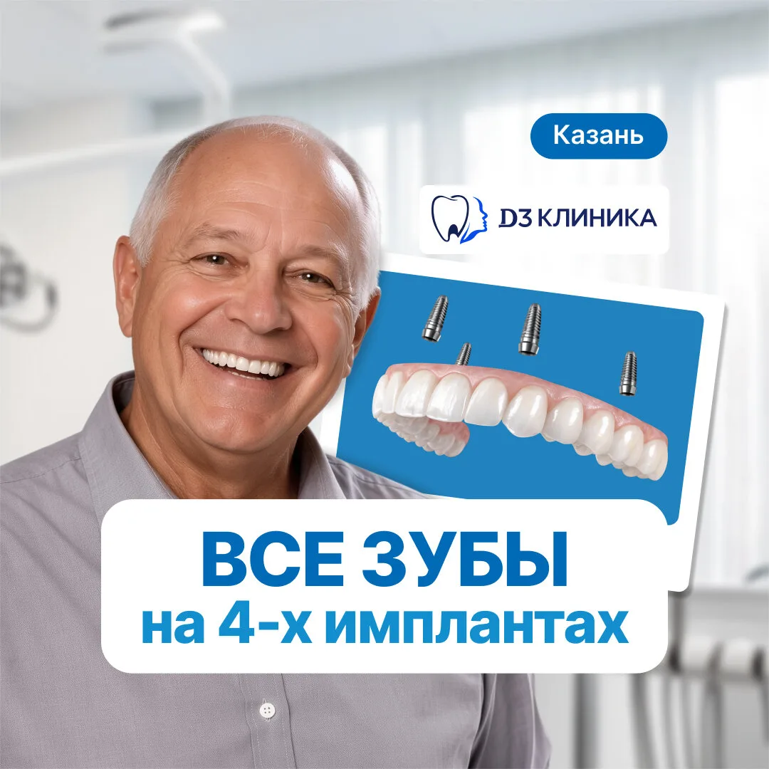 Несъёмное протезирование всей челюсти на 4-х имплантах