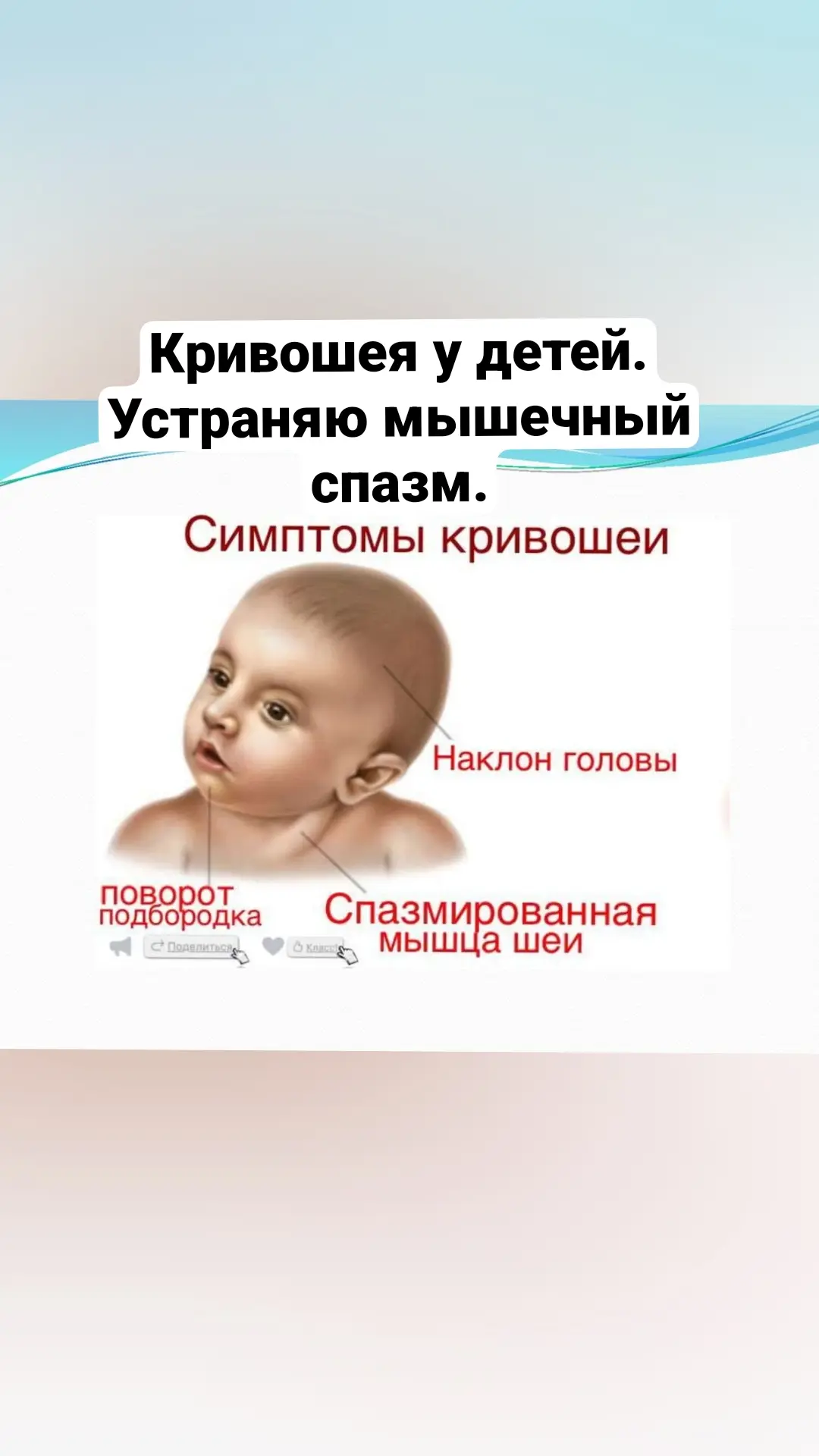 🆘 КРИВОШЕЯ У РЕБЕНКА: Почему иглы, тейпирование, массаж, лфк, ортез не помогают и что ...