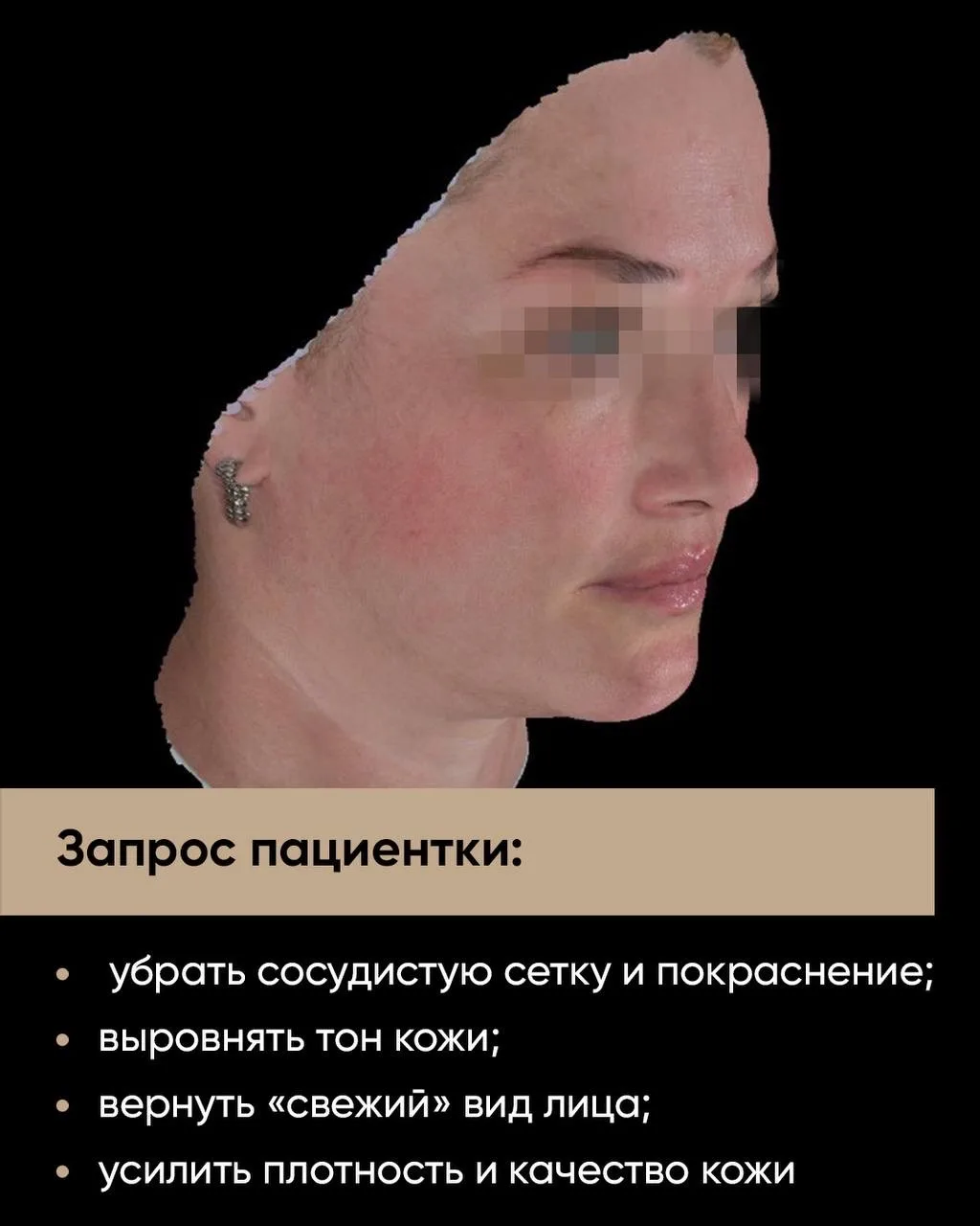 Сосуды, покраснение и «усталое» лицо — одна из самых частых причин, с которой пациенты ...