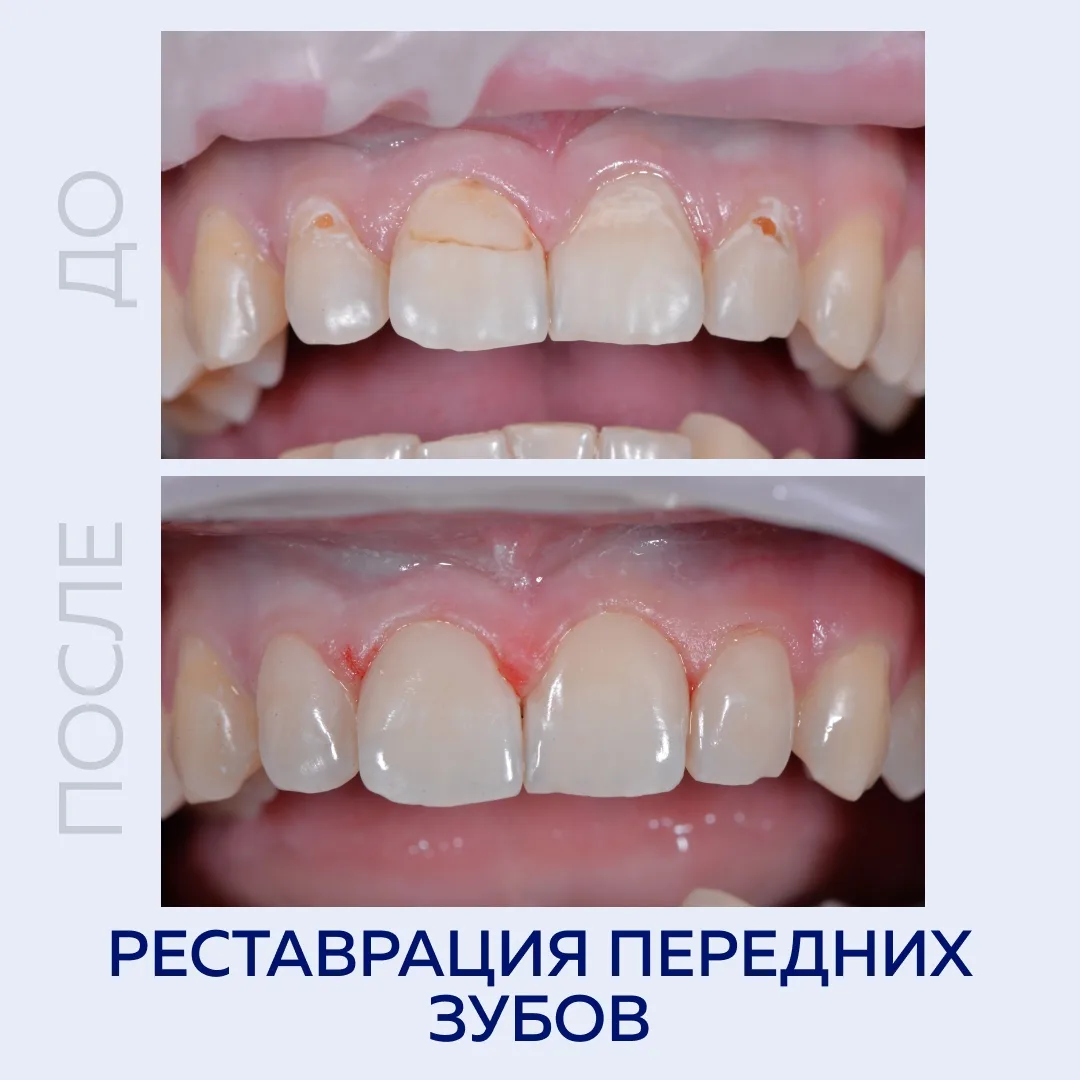 Реставрация передних зубов.
 
Работа стоматолога-терапевта Кривоноговой Валентины Дмитриевны.
 
Паци