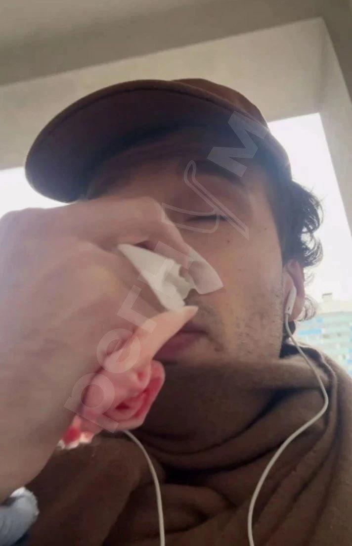 Мужчина, которого сбили двое на одном самокате в Ленобласти, написал заявление в полици...