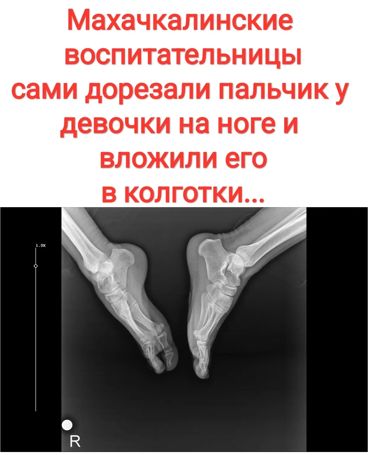 Воспитатели сами дорезали двухлетней девочке палец, который она прищемила дверью в махачкалинском де