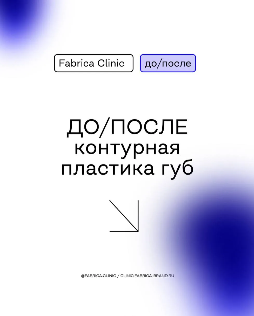 КОНТУРНАЯ ПЛАСТИКА ГУБ