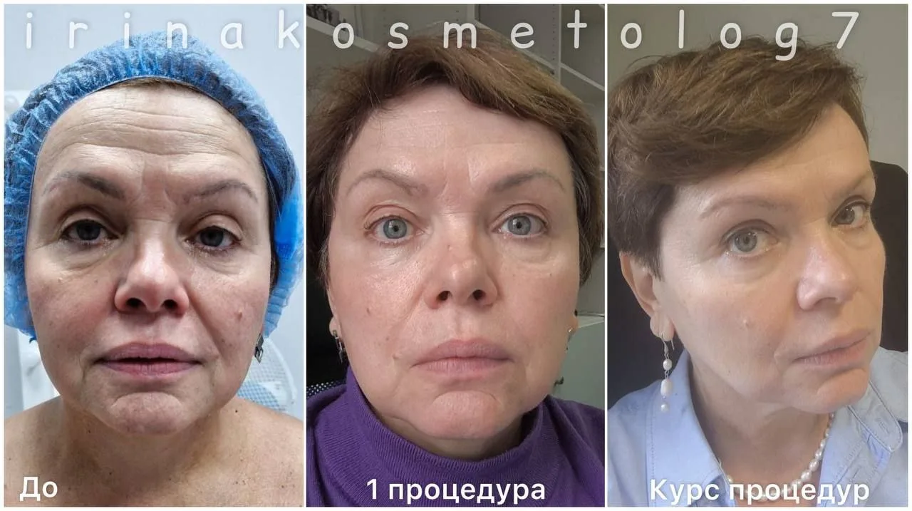 После перерыва наших процедур, мы повторили несколько раз микроигольчатый rf лифтинг и ...